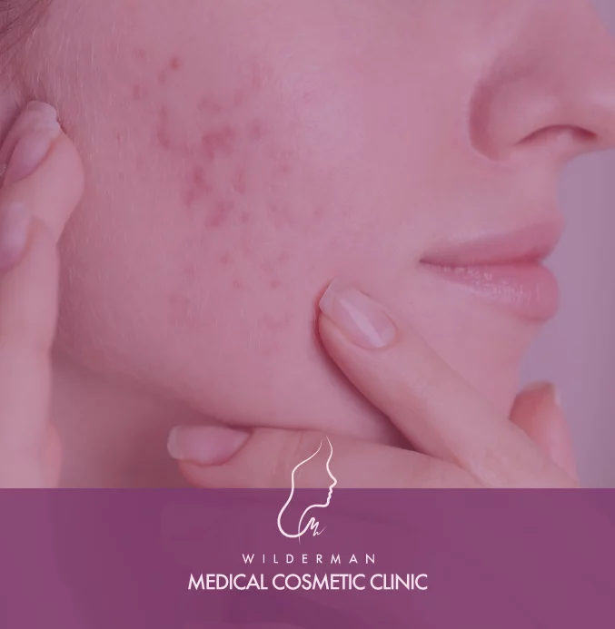 Botox® Wrinkles Solutions