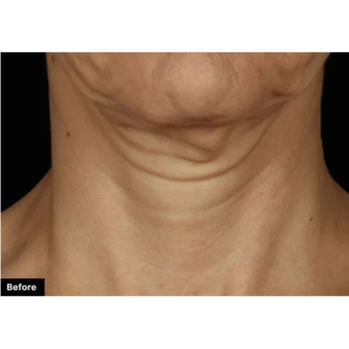 SkinCeuticals - Tripeptide-R Neck Repair Anti-Aging Cream - Products Before Results -